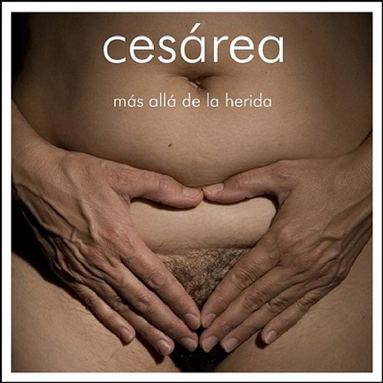 Cesrea